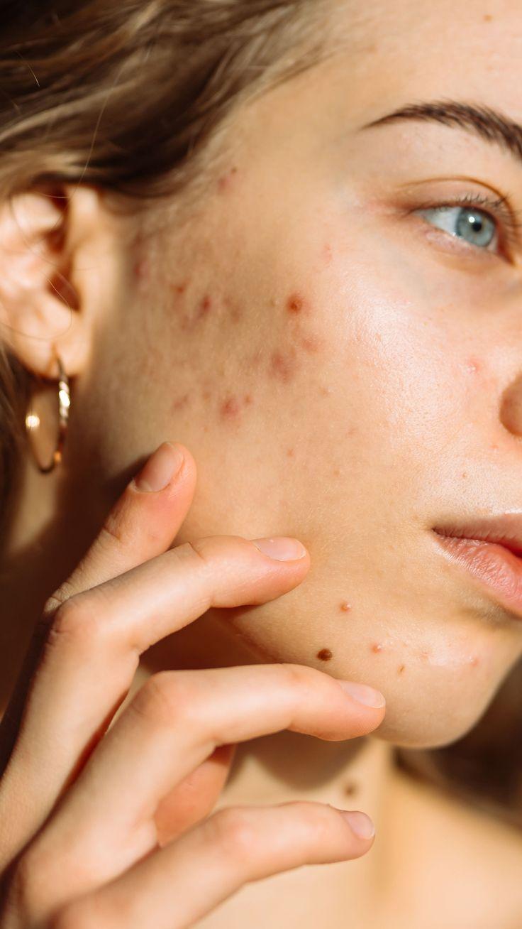 Taches Pigmentaires & Teint Irrégulier